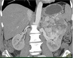 Islet Cell Tumor - CTisus CT Scan