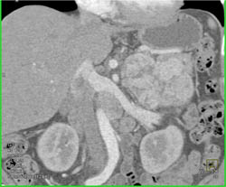 Islet Cell Tumor - CTisus CT Scan