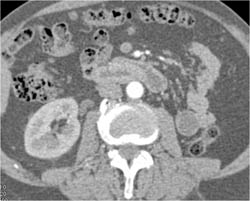 Islet Cell Tumor - CTisus CT Scan