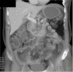 Duodenal Mass Simulates A Pancreatic Mass - CTisus CT Scan