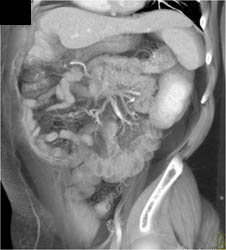 Intraductal Papillary Mucinous Neoplasm (IPMN) in Tail of the Pancreas - CTisus CT Scan