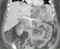 Carcinoma in Tail of the Pancreas and Liver Metastases - CTisus CT Scan