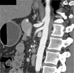 Normal SMA and Celiac - CTisus CT Scan