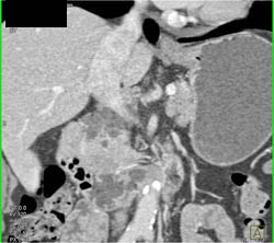 Antral Ulcerations S/P Rt - CTisus CT Scan