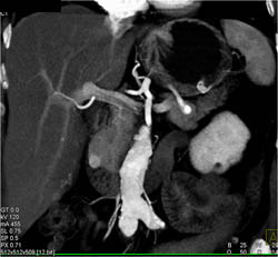 1 Cm Insulinoma in Uncinate Process - CTisus CT Scan