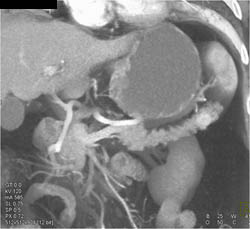 Islet Cell Tumor in Tail of Pancreas - CTisus CT Scan