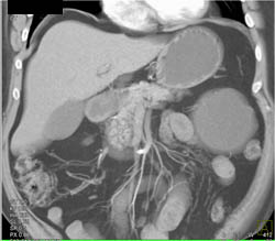 Cystadenoma - CTisus CT Scan