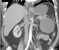 Cystadenoma - CTisus CT Scan