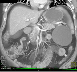 Cystadenoma - CTisus CT Scan