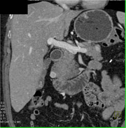 Islet Cell Tumor - CTisus CT Scan