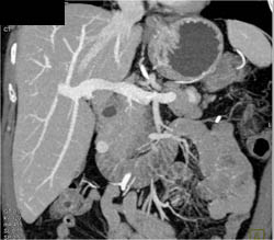 Islet Cell Tumor - CTisus CT Scan