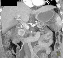 Islet Cell Tumor - CTisus CT Scan