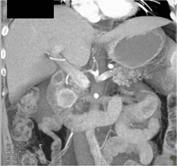 Islet Cell Tumor - CTisus CT Scan