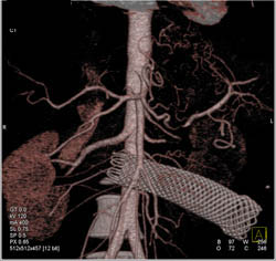 Stent in Duodenum Invaded By Pancreatic Cancer. PV/SMV Encasement Seen - CTisus CT Scan