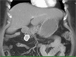 Calcified Node Near Pancreas - CTisus CT Scan