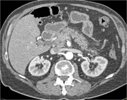 Adenocarcinoma of the Pancreas Encases the PV/SMV - CTisus CT Scan