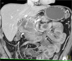 Pancreatic Tumor Encases the PV/SMV - CTisus CT Scan