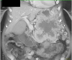 Vipoma - CTisus CT Scan