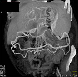 Tail of Pancreas Tumor Encases the Splenic Vein - CTisus CT Scan