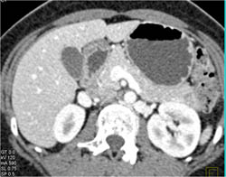 1 Cm Intraductal Papillary Mucinous Neoplasm (IPMN) in Tail of Pancreas - CTisus CT Scan