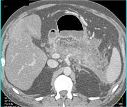 Acute Pancreatitis - CTisus CT Scan