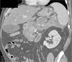 Acute Pancreatitis - CTisus CT Scan