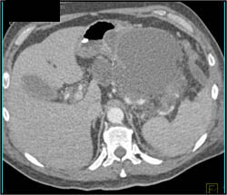 Pancreatic Necrosis and Pseudocyst - CTisus CT Scan