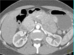 Islet Cell Tumor - CTisus CT Scan