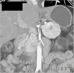 Islet Cell Tumor - CTisus CT Scan