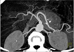 Islet Cell Tumor - CTisus CT Scan