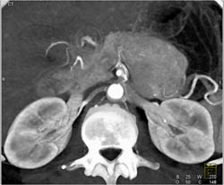 Islet Cell Tumor - CTisus CT Scan