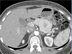 Islet Cell Tumor - CTisus CT Scan