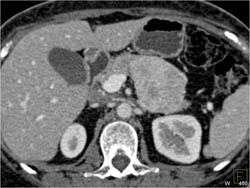 Islet Cell Tumor - CTisus CT Scan