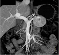 Islet Cell Tumor - CTisus CT Scan