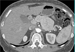 Islet Cell Tumor - CTisus CT Scan