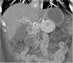 Islet Cell Tumor - CTisus CT Scan