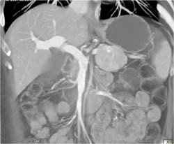 Islet Cell Tumor - CTisus CT Scan