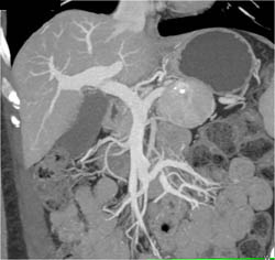 Islet Cell Tumor - CTisus CT Scan