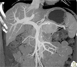 Islet Cell Tumor - CTisus CT Scan