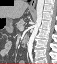 Pancreatic Adenocarcinoma - CTisus CT Scan