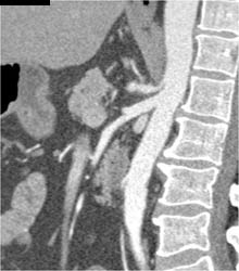 Pancreatic Adenocarcinoma - CTisus CT Scan