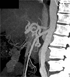 Pancreatic Adenocarcinoma - CTisus CT Scan