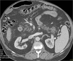 Fatty Replacement Pancreas With Cyst, Tail of Pancreas - CTisus CT Scan