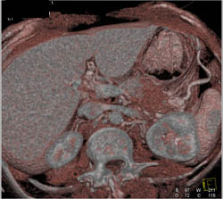 Pancreatitis With Peripancreatic Fluid Simulates A Mass - CTisus CT Scan