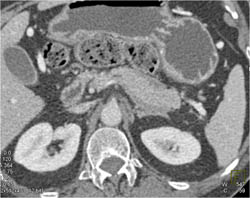 Mild Pancreatitis in Peri-pancreatic Space - CTisus CT Scan