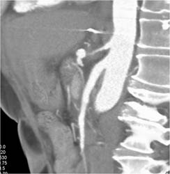 Encases Celiac Axis - CTisus CT Scan