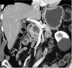 Intraductal Papillary Mucinous Neoplasm (IPMN) - CTisus CT Scan