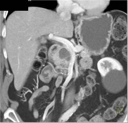 Intraductal Papillary Mucinous Neoplasm (IPMN) - CTisus CT Scan