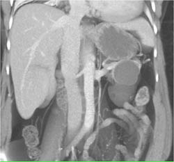 Cystadenoma - CTisus CT Scan