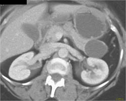 Cystadenoma - CTisus CT Scan